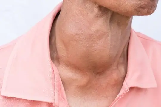 Hiểu thêm về bướu giáp tái phát image 1