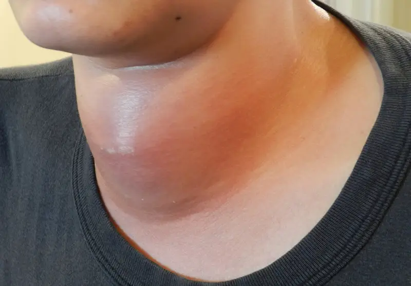 Viêm tuyến giáp bán cấp có trị khỏi không? image