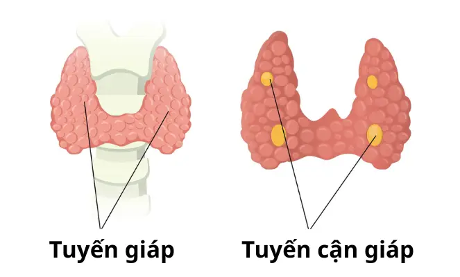 Điều trị hiệu quả Cường cận giáp/Tăng sản tuyến cận giáp Page benh ly tuyen giap 2
