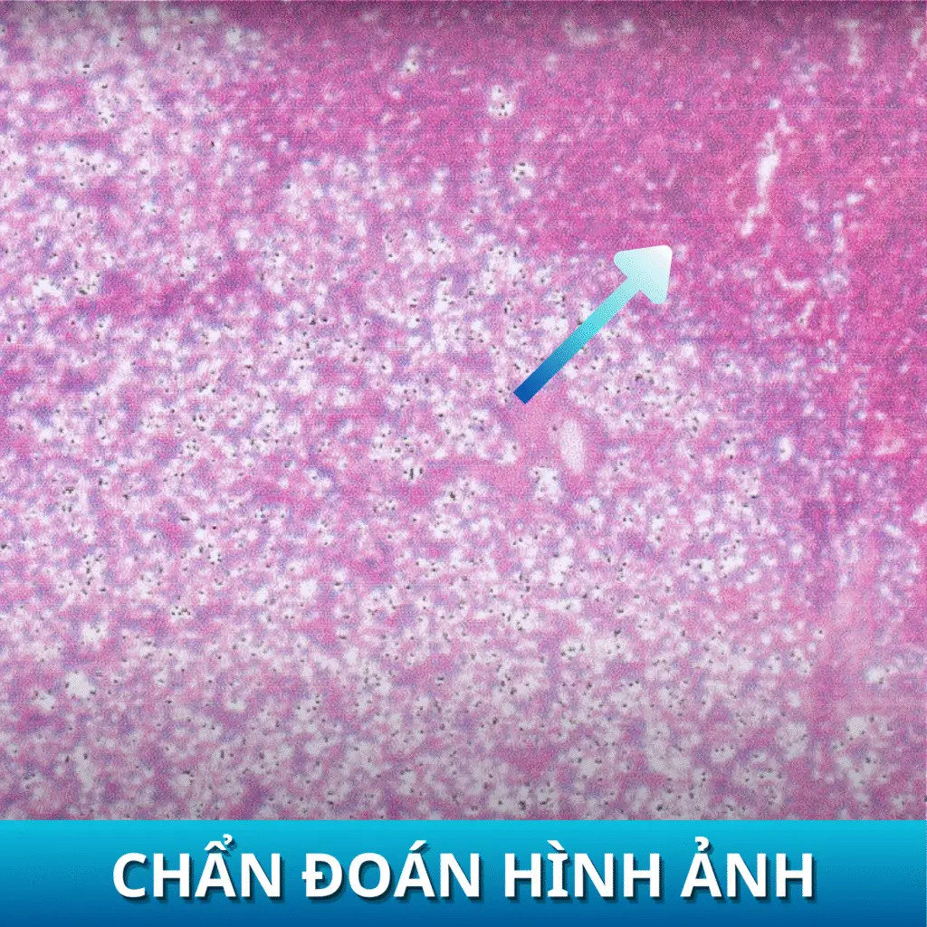 Điều trị hiệu quả Cường cận giáp/Tăng sản tuyến cận giáp Sau khi mo thanh cong